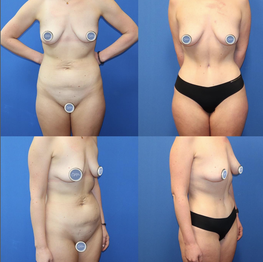 Tummy Tuck Procedure - A visual representation showcasing the process and results of a tummy tuck for a client, emphasizing the transformative changes in the abdominal area.