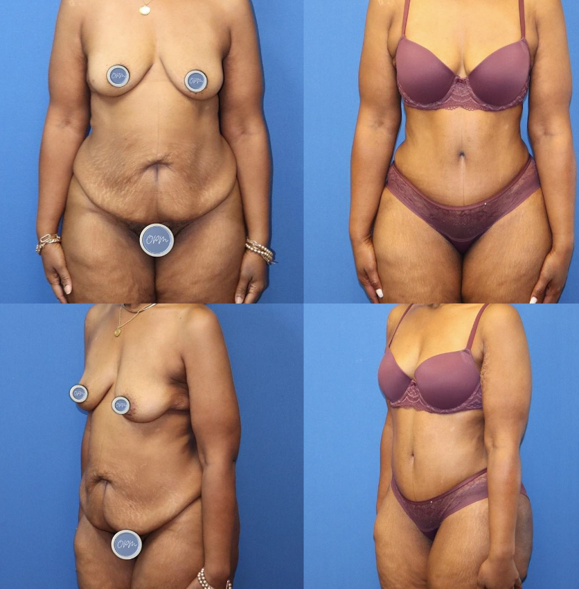 Before and After: Tummy Tuck Procedure in Houston. On the left, the 'Before' image featuring a woman client with front and side views, and on the right, the corresponding 'After' image displaying the transformative results post-procedure.