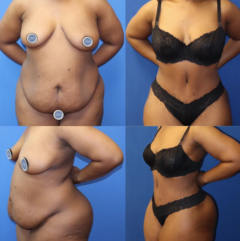 Remarkable Transformation: Female client's before-and-after pictures following a tummy tuck procedure, illustrating the successful outcome and transformative results.