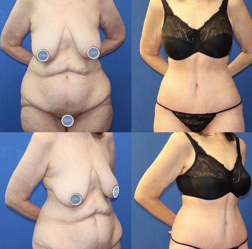 Before and After: Tummy Tuck Transformation. On the left, two images depict the front and side views before the procedure, and on the right, witness the remarkable after results of a tummy tuck procedure, particularly enhancing the figure of an aged client