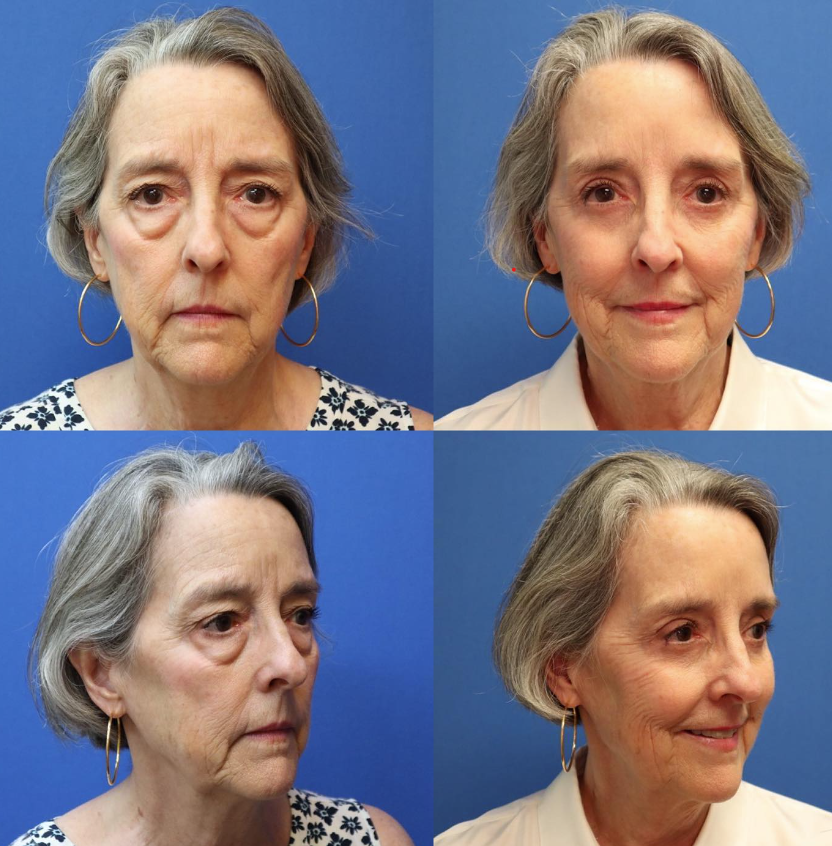 Before and After: Blepharoplasty Transformation. Left side displays the client's initial appearance, an older woman, and the right side showcases the remarkable results post-blepharoplasty, emphasizing the enhancement of the eyes.