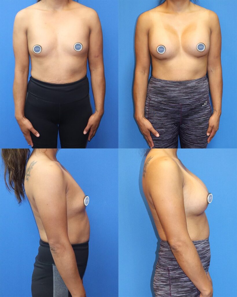 Houston, TX Breast Augmentation Journey: Left side features the patient's initial appearance, while the right side reveals the remarkable transformation post-surgery in this before-and-after image.