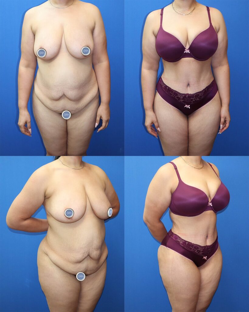 Houston Tummy Tuck Transformation: Left image displaying the pre-procedure state of a woman's abdomen, and on the right, witness the impressive post-surgery results, showcasing the transformative journey.