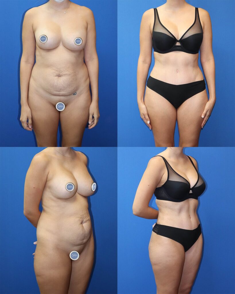 Transformative Tummy Tuck: On the left, view the 'before' image, and on the right, witness the remarkable post-procedure results for a woman in Houston, showcasing the significant changes achieved.