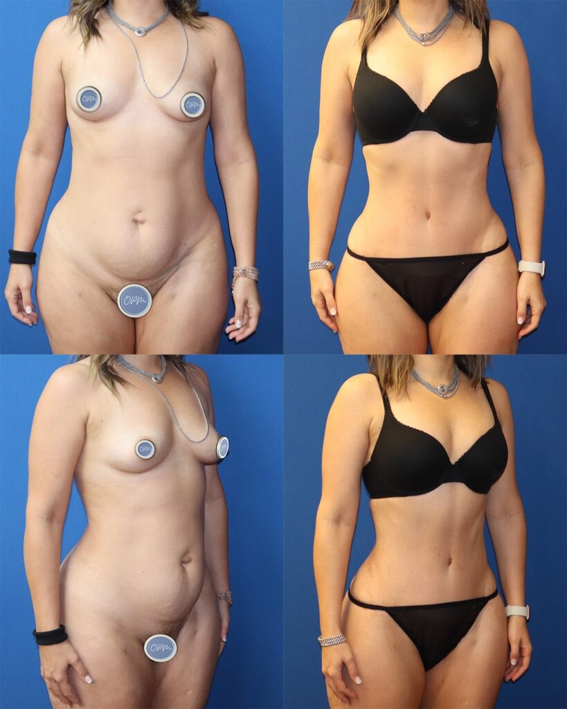 Tummy Tuck Transformation. Left side reveals the client's pre-surgery appearance, while the right side displays the striking after pictures, illustrating the successful and transformative results of the procedure.
