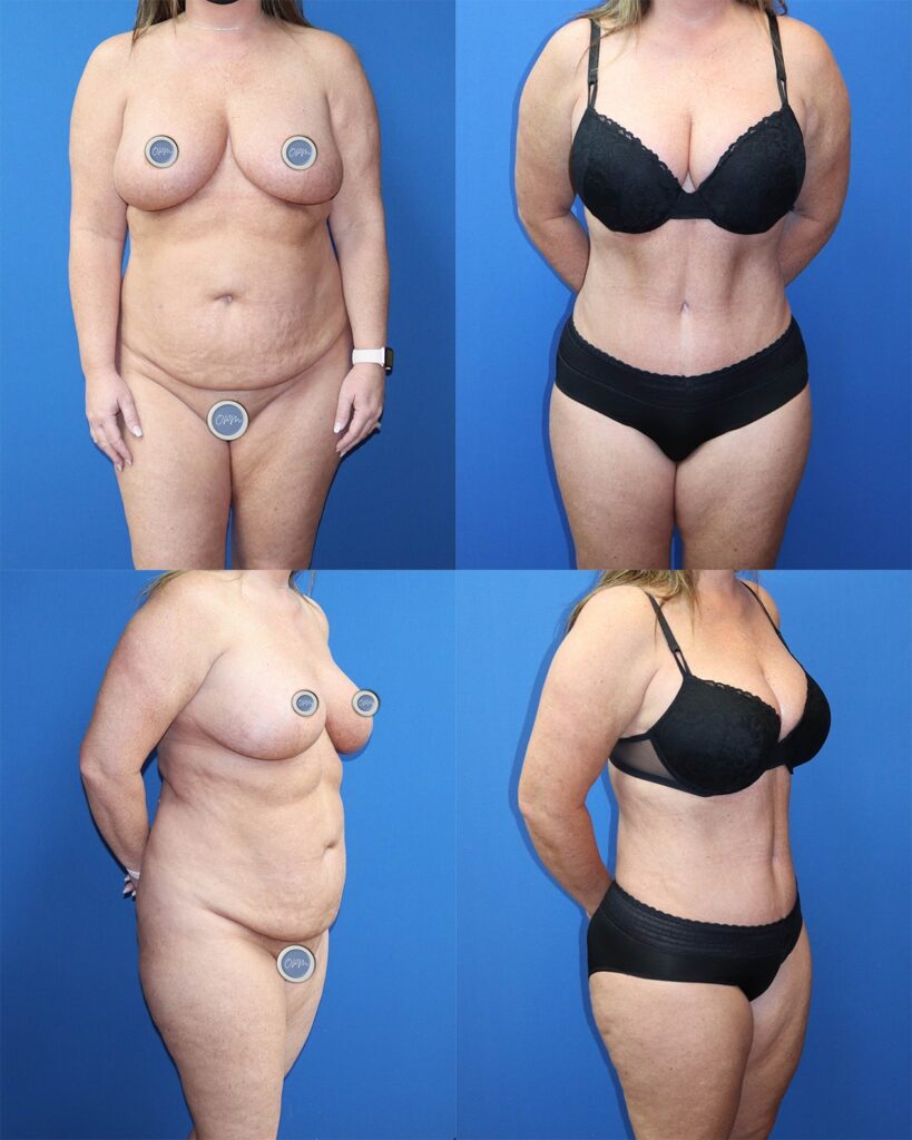 Tummy Tuck Success: Before-and-after image featuring a woman's abdomen, with the left side presenting the pre-procedure appearance and the right side revealing the impressive post-surgery results.