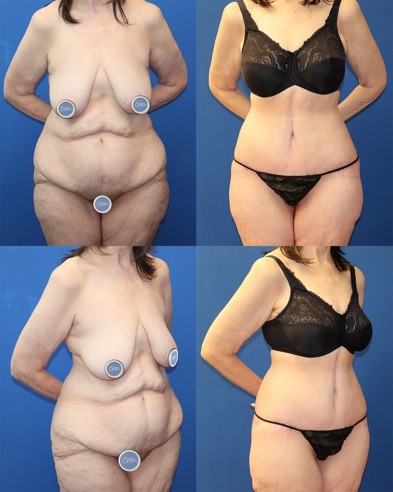 Successful Tummy Tuck Procedure: Before and after pictures of a female client in Houston, showcasing the transformative results of the procedure.