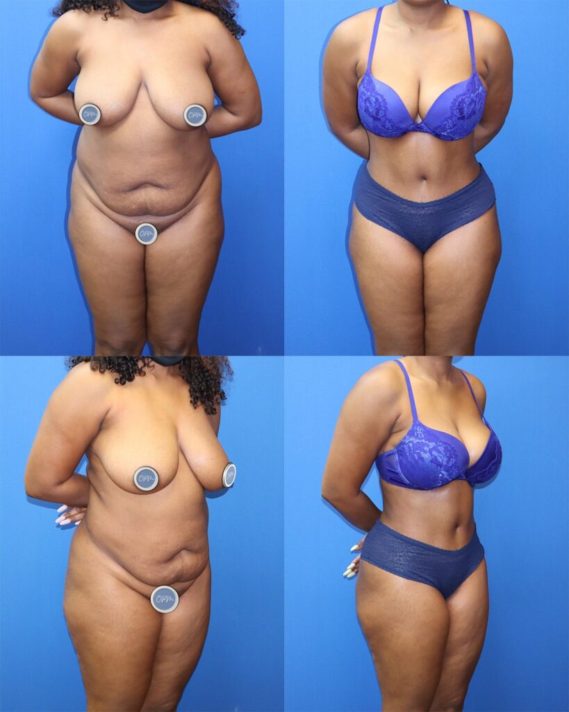 Transformation Unveiled: Before-and-after images capturing the success of a tummy tuck procedure on a female client in Houston, revealing the impressive results.