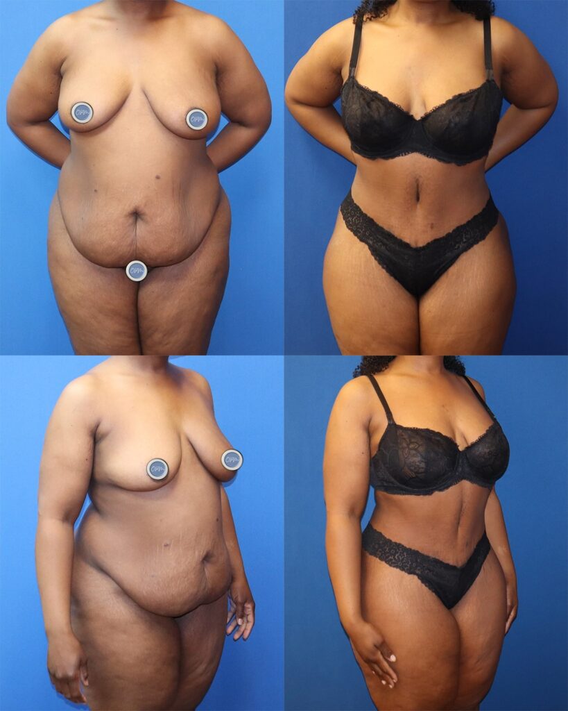Houston Tummy Tuck Transformation - Left image presenting the client's initial appearance, and on the right, the remarkable transformation post-surgery.