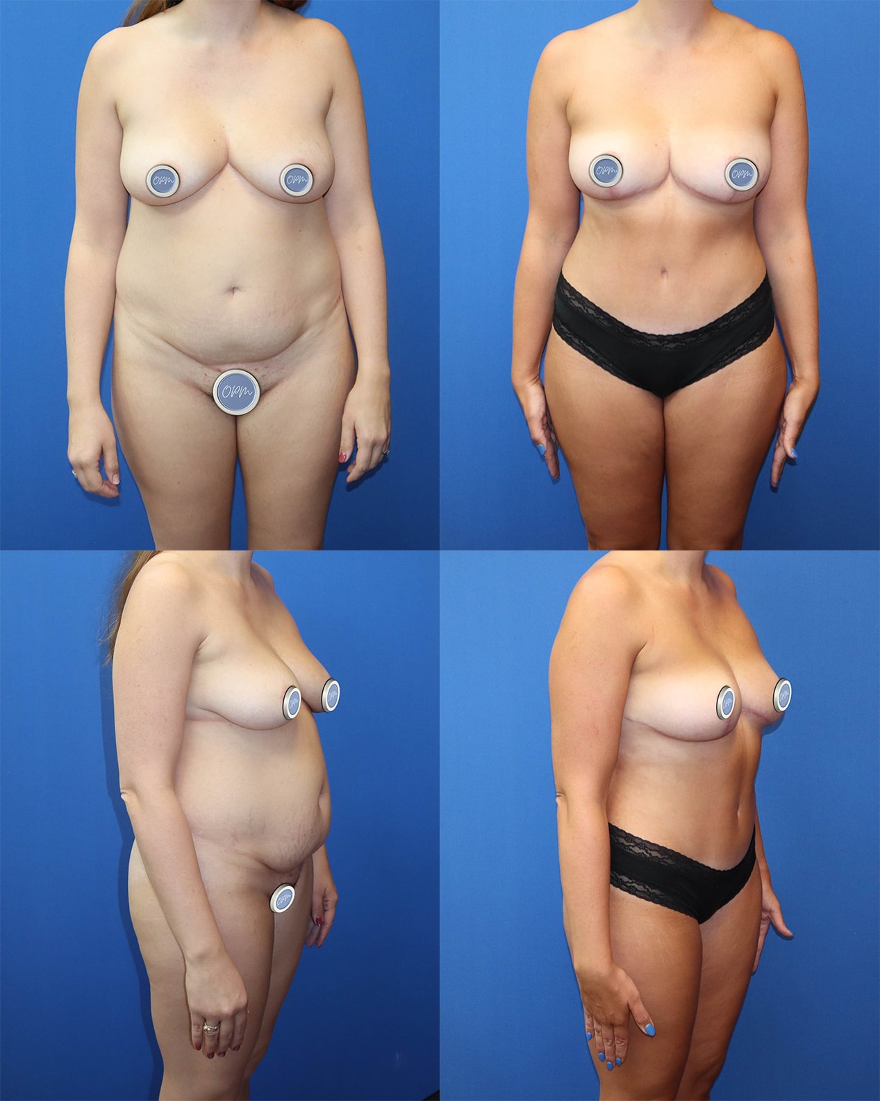 Tummy Tuck Success - Before-and-after images capturing the impressive results of a successful procedure on the client's abdomen.