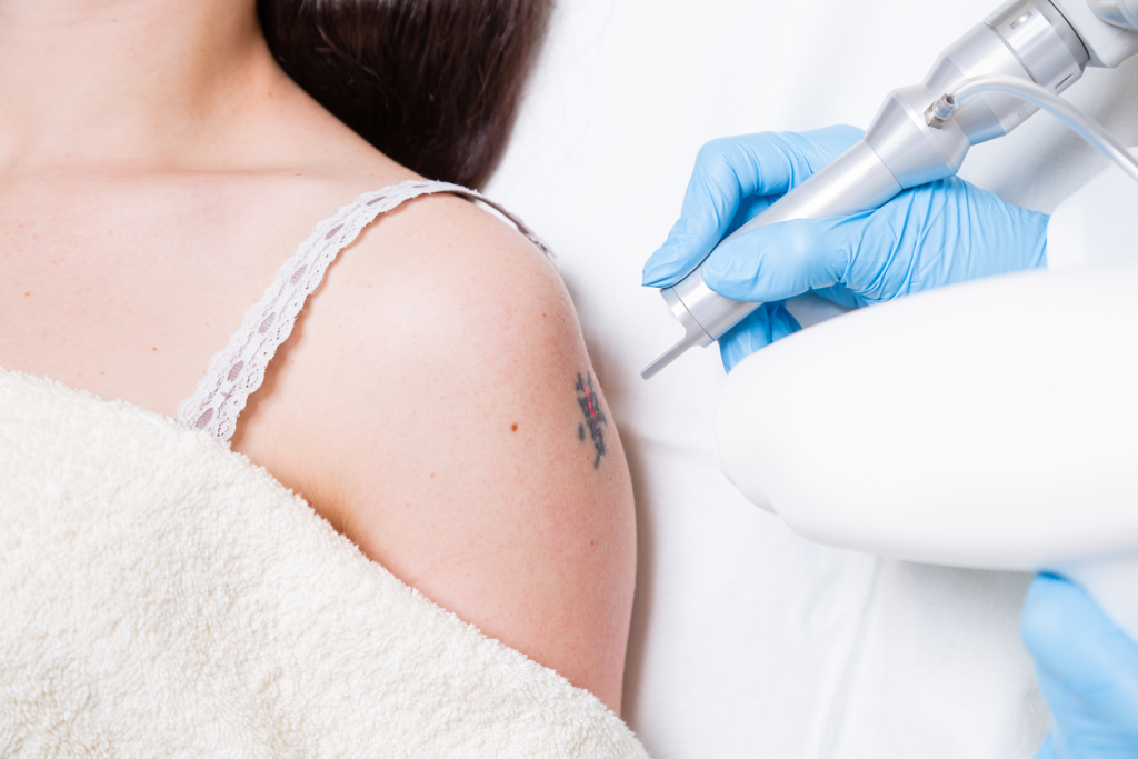 Laser Tattoo Removal - Houston, TX