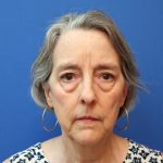 Blepharoplasty Before & After Patient #882