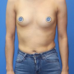 Breast Augmentation Before & After Patient #895