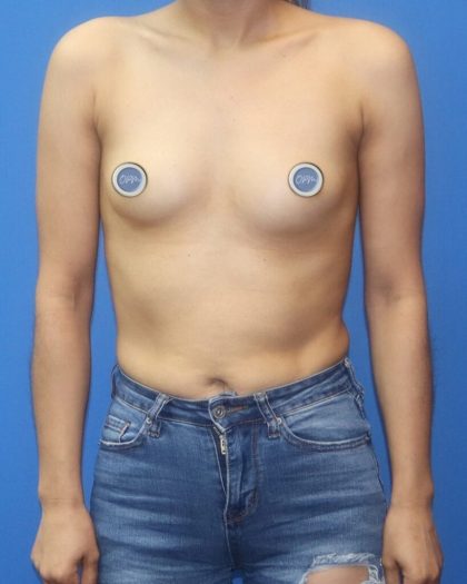 Breast Augmentation Before & After Patient #895