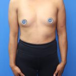 Breast Augmentation Before & After Patient #902