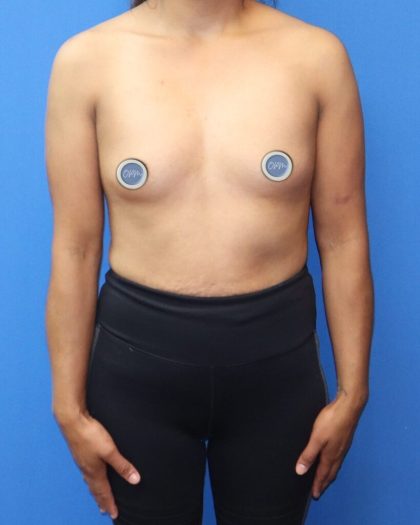 Breast Augmentation Before & After Patient #902