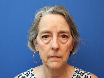Blepharoplasty Before & After Patient #882