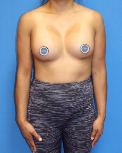 Breast Augmentation Before & After Patient #902