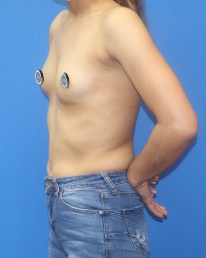 Breast Augmentation Before & After Patient #895