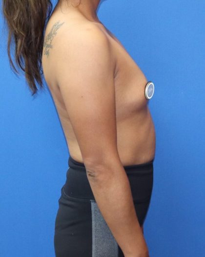 Breast Augmentation Before & After Patient #902