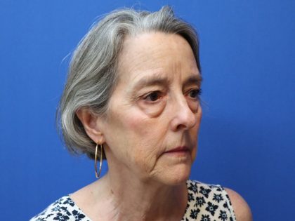 Blepharoplasty Before & After Patient #882