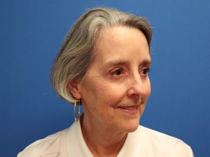 Blepharoplasty Before & After Patient #882