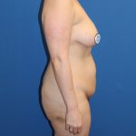Breast Augmentation Before & After Patient #894