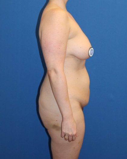 Tummy Tuck Before & After Patient #980