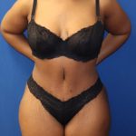 Tummy Tuck Before & After Patient #973