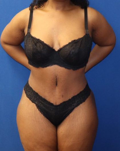 Tummy Tuck Before & After Patient #973