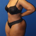 Tummy Tuck Before & After Patient #973