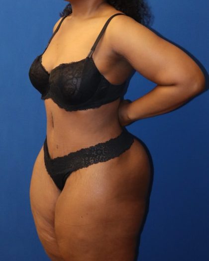 Tummy Tuck Before & After Patient #973