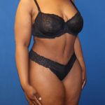 Tummy Tuck Before & After Patient #973