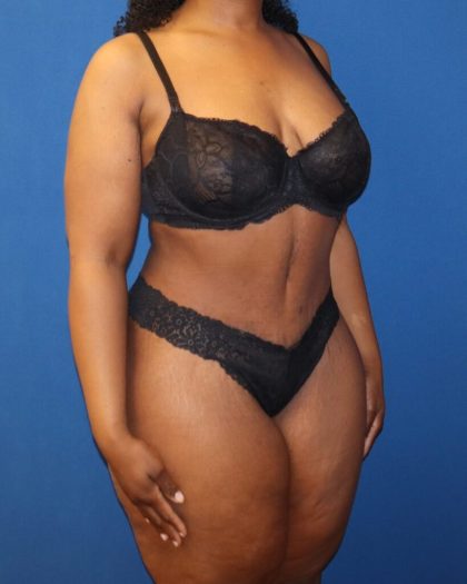 Tummy Tuck Before & After Patient #973