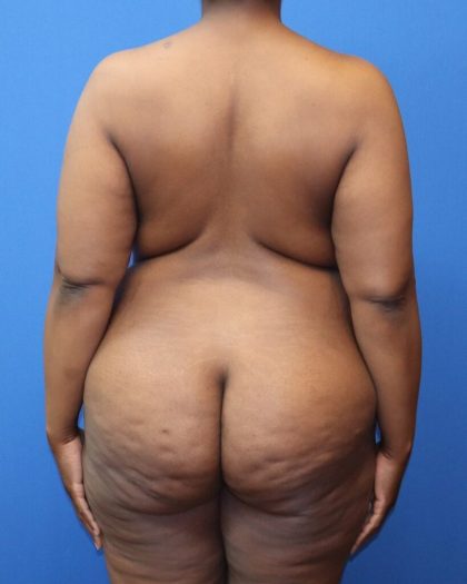 Tummy Tuck Before & After Patient #973