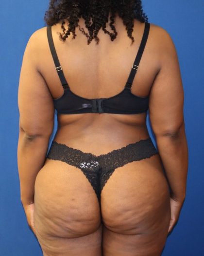 Tummy Tuck Before & After Patient #973
