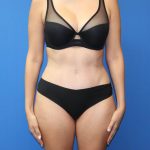 Tummy Tuck Before & After Patient #975