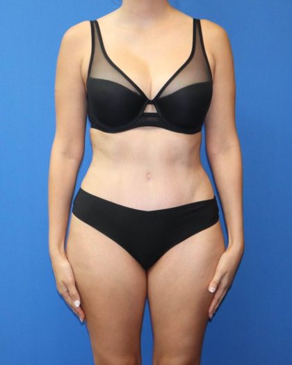Tummy Tuck Before & After Patient #975