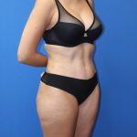 Tummy Tuck Before & After Patient #975