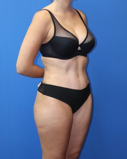 Tummy Tuck Before & After Patient #975