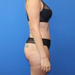 Tummy Tuck Before & After Patient #975