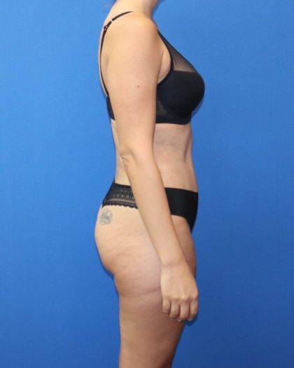 Tummy Tuck Before & After Patient #975