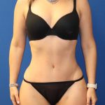 Tummy Tuck Before & After Patient #976