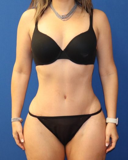 Tummy Tuck Before & After Patient #976