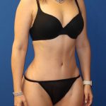 Tummy Tuck Before & After Patient #976