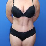 Tummy Tuck Before & After Patient #977