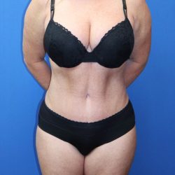 Tummy Tuck Before & After Patient #977