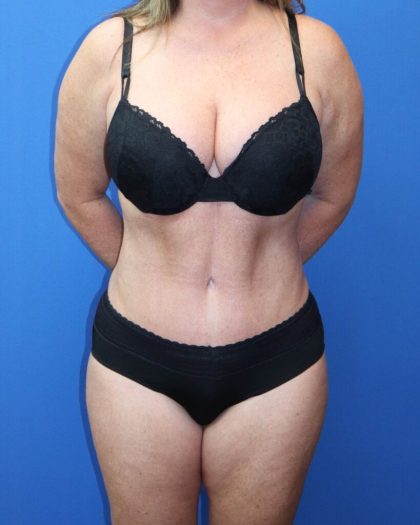 Tummy Tuck Before & After Patient #977
