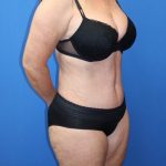 Tummy Tuck Before & After Patient #977