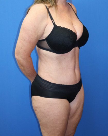 Tummy Tuck Before & After Patient #977